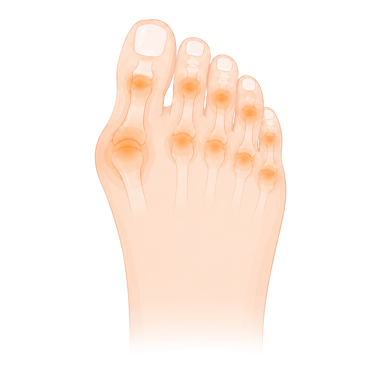 Rheumatic foot