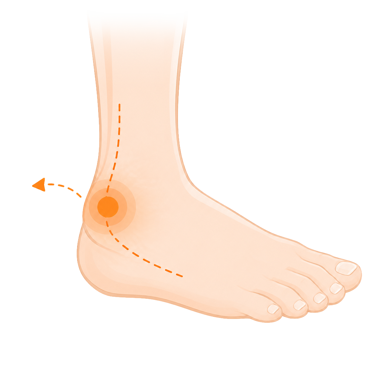 Lateral ankle sprain (eversion injury)