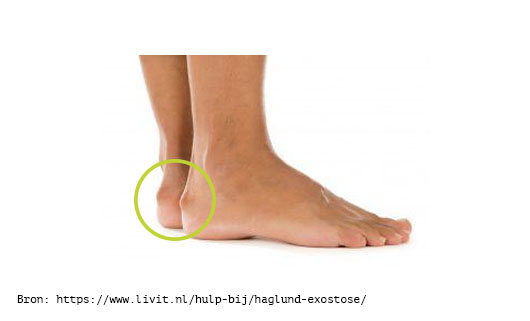 Haglund’s exostosis