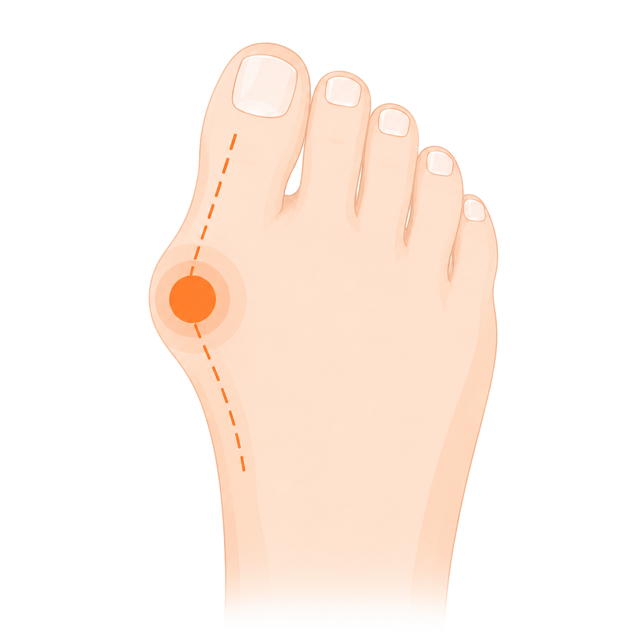 Hallux Valgus Rondom