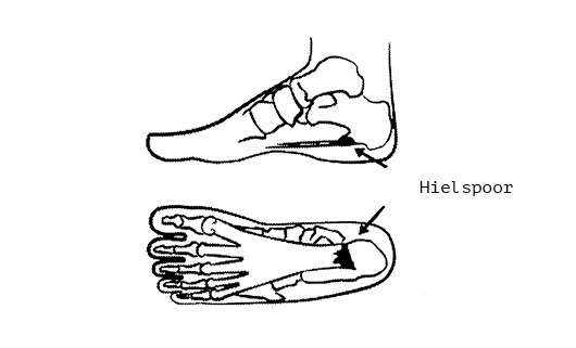 heel spur