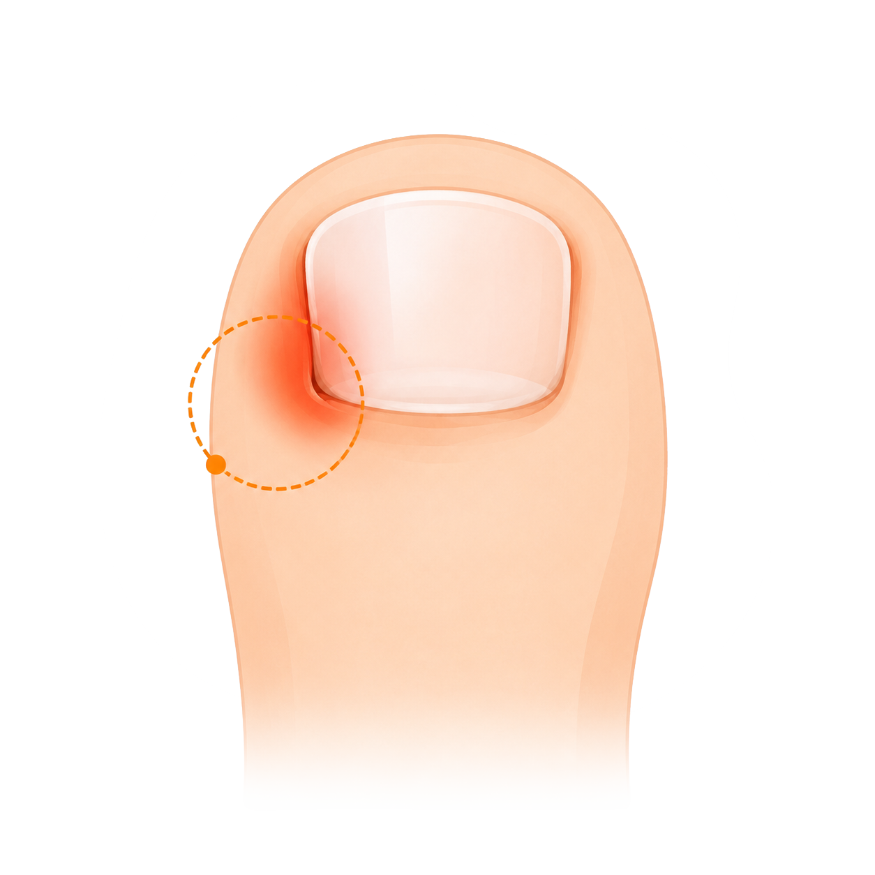 Ingegroeide nagel Rondom