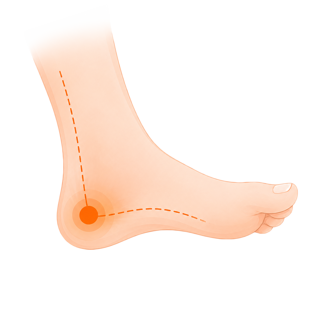Tendinitis 