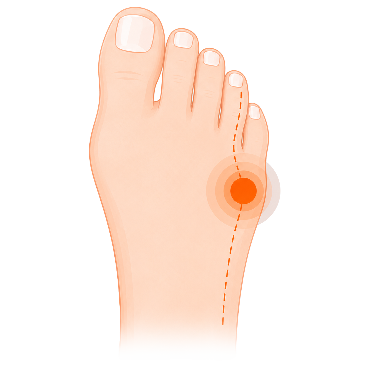 Pain on the outside of the foot