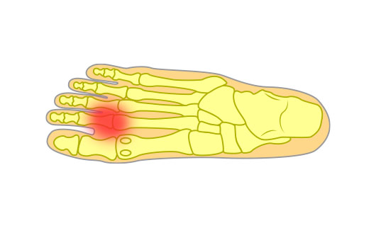 Freiberg’s disease
