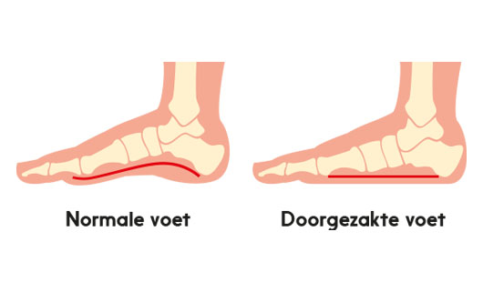 flat foot