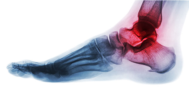 gout