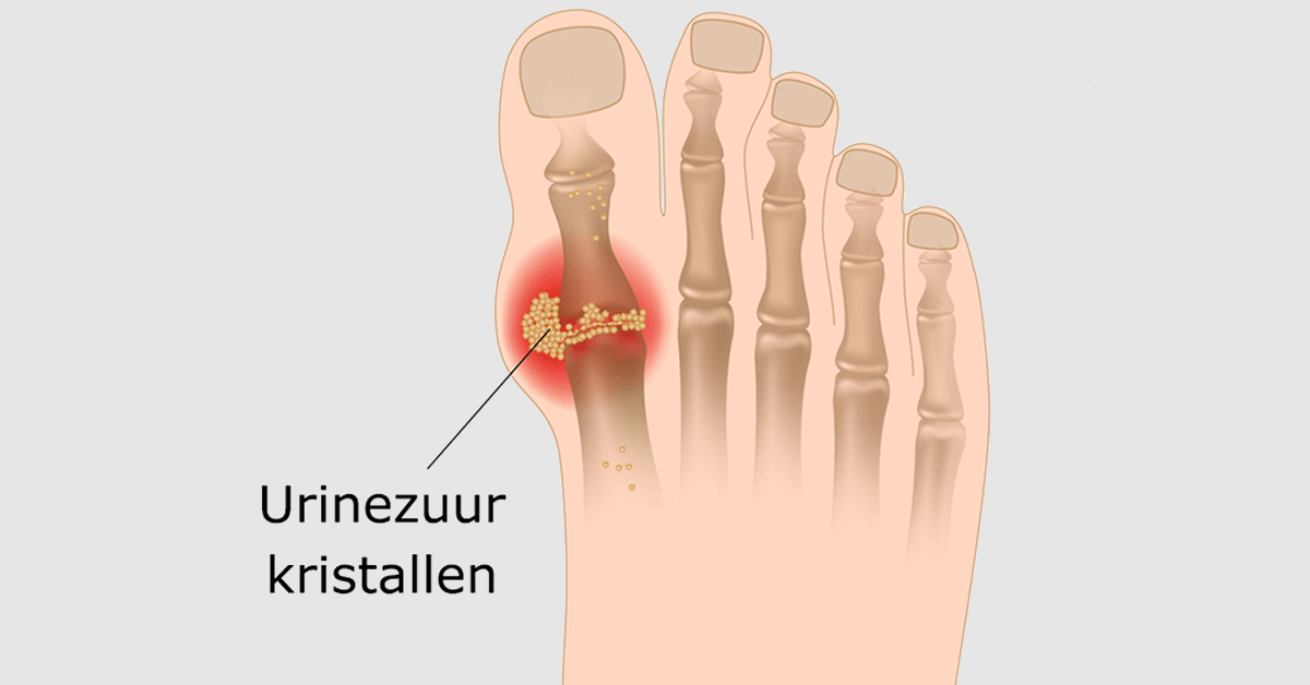 gout pain
