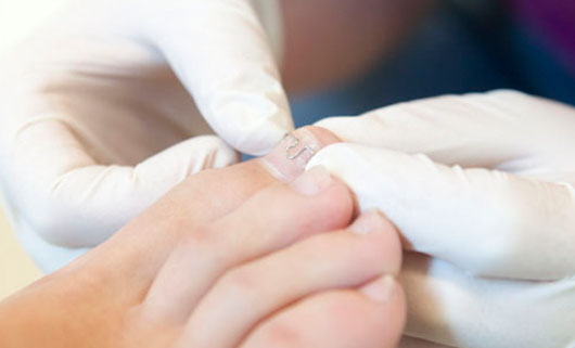nail brace