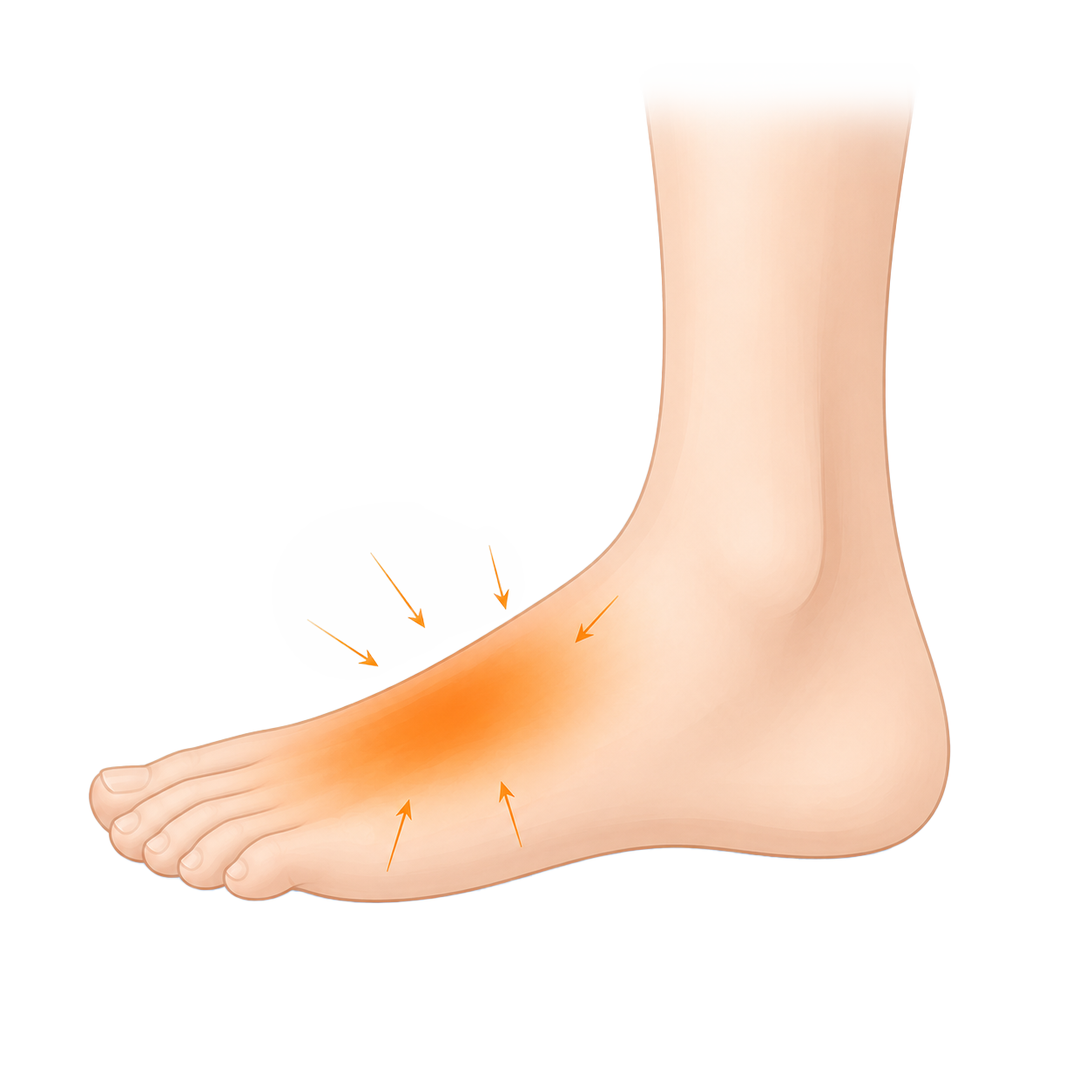 overuse-V1 (foot)